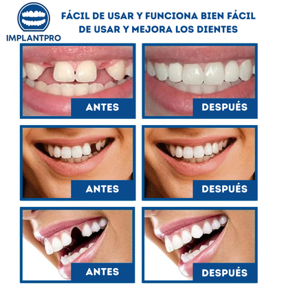 IMPLANTPRO | SONRISA NATURAL Y ESTÉTICA PARA UNA CONFIANZA RENOVADA