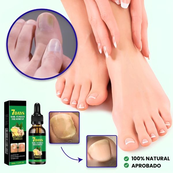 TRATAMIENTO ANTI HONGOS 7 DÍAS 100% NATURAL