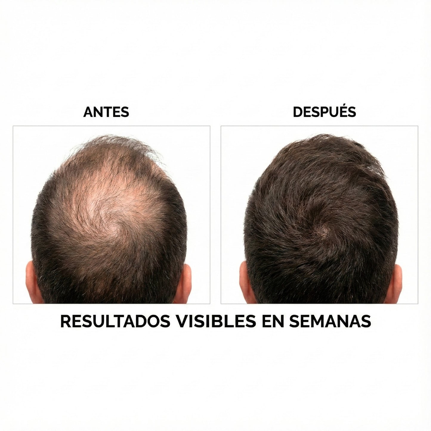 Minoxidil Pro™ 5% – Volumen, Fuerza y Regeneración Capilar